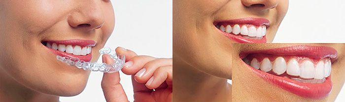 マウスピース矯正(インビザラインGo)